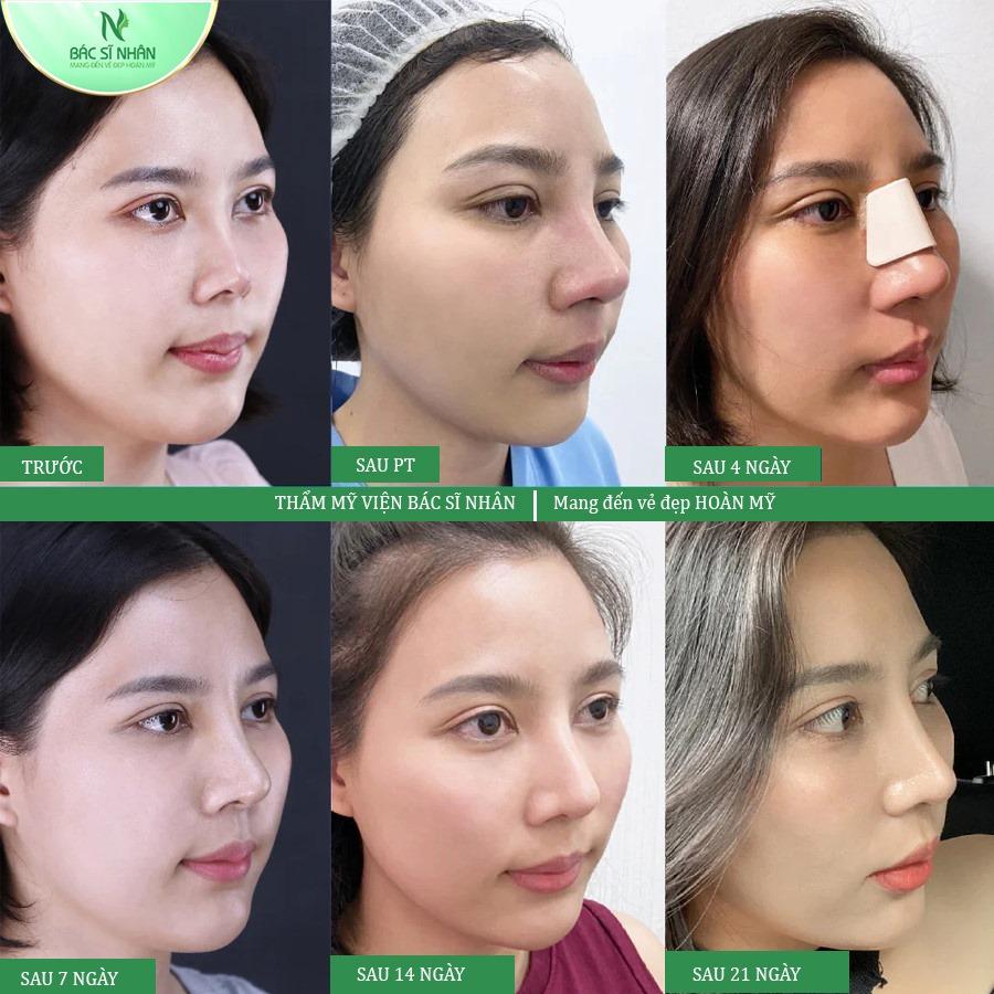 Top 5 Địa Chỉ Nâng Mũi Đẹp Tự Nhiên & Đáng Tin Cậy Nhất Đà Nẵng