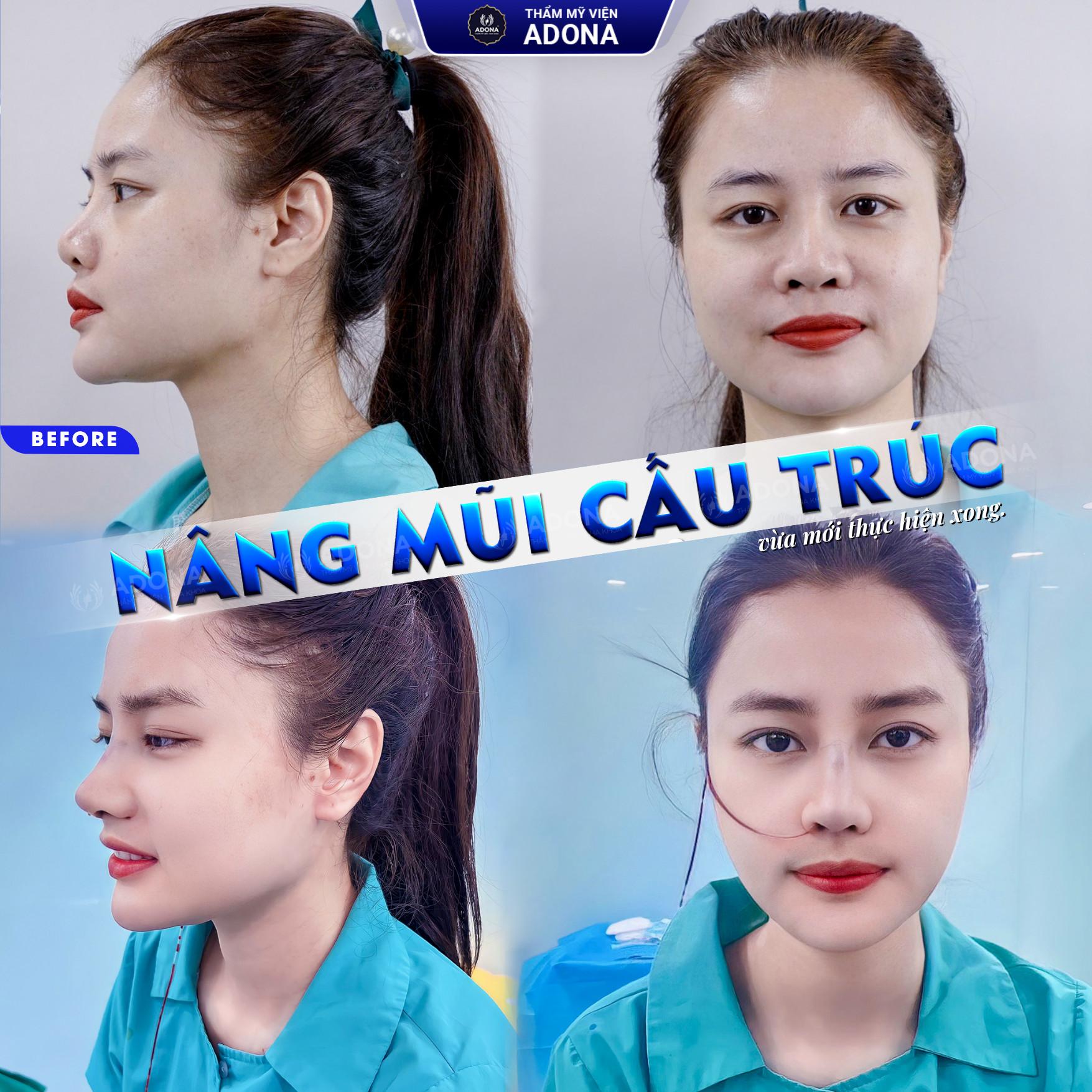 5 địa chỉ nâng mũi chất lượng và uy tín bậc nhất tại quận 3, TP.HCM
