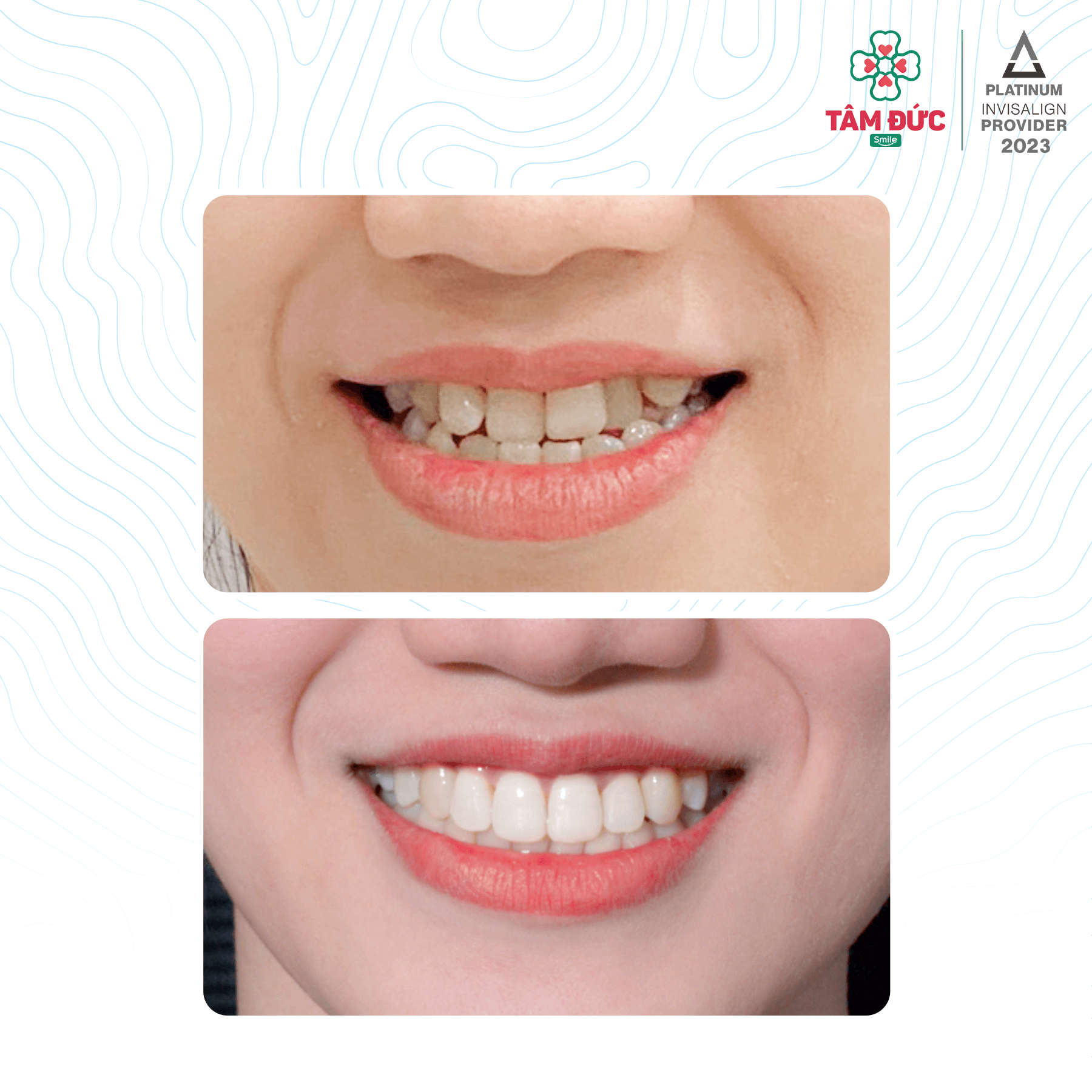 Top 5 địa chỉ niềng răng chất lượng và đáng tin cậy hàng đầu tại quận Tân Bình, TP.HCM