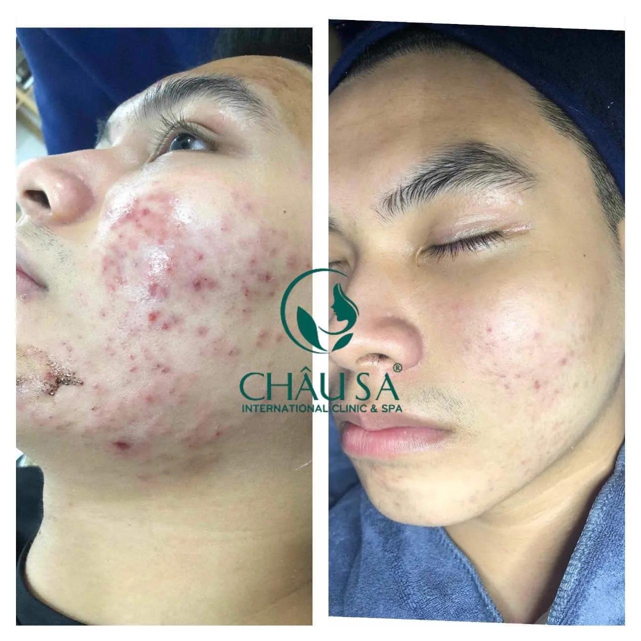 9 Địa chỉ Spa trị mụn chất lượng nhất tại Quảng Ngãi