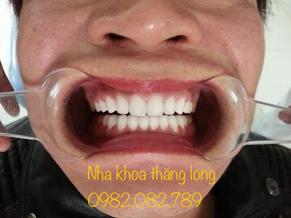 Top 5 địa chỉ tẩy trắng răng đáng tin cậy và chất lượng nhất tại Hà Nam