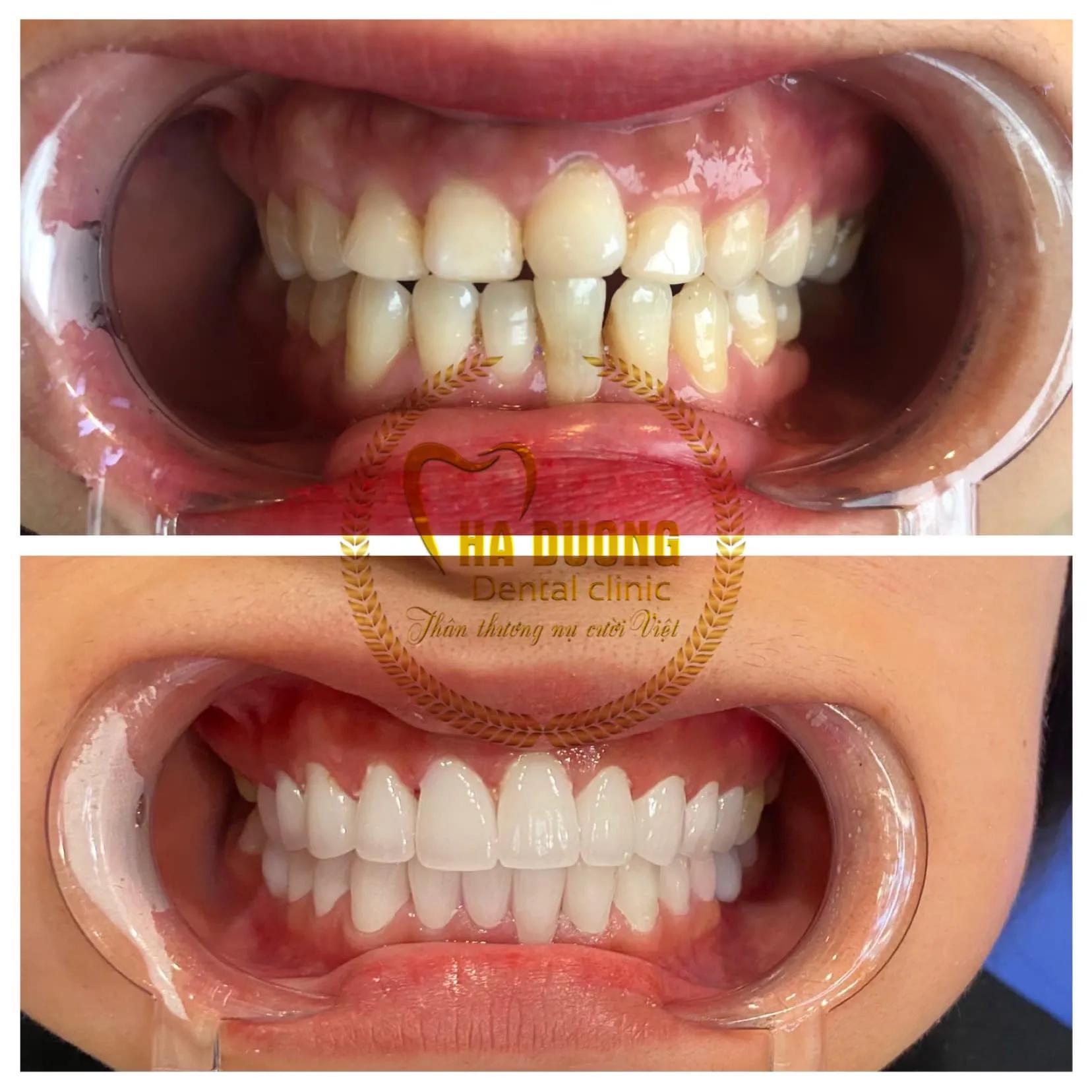 Top 7 Địa chỉ bọc răng sứ uy tín và đẹp nhất tại quận Long Biên, Hà Nội