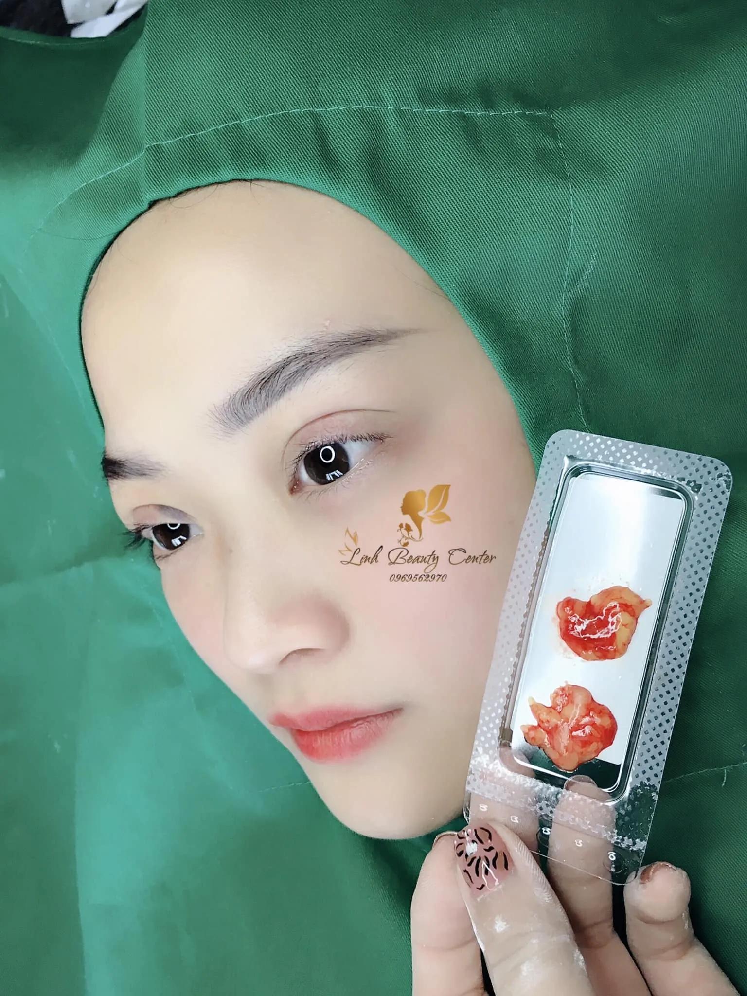 Top 8 địa chỉ nhấn mí, cắt mí đẹp và uy tín tại Bắc Giang
