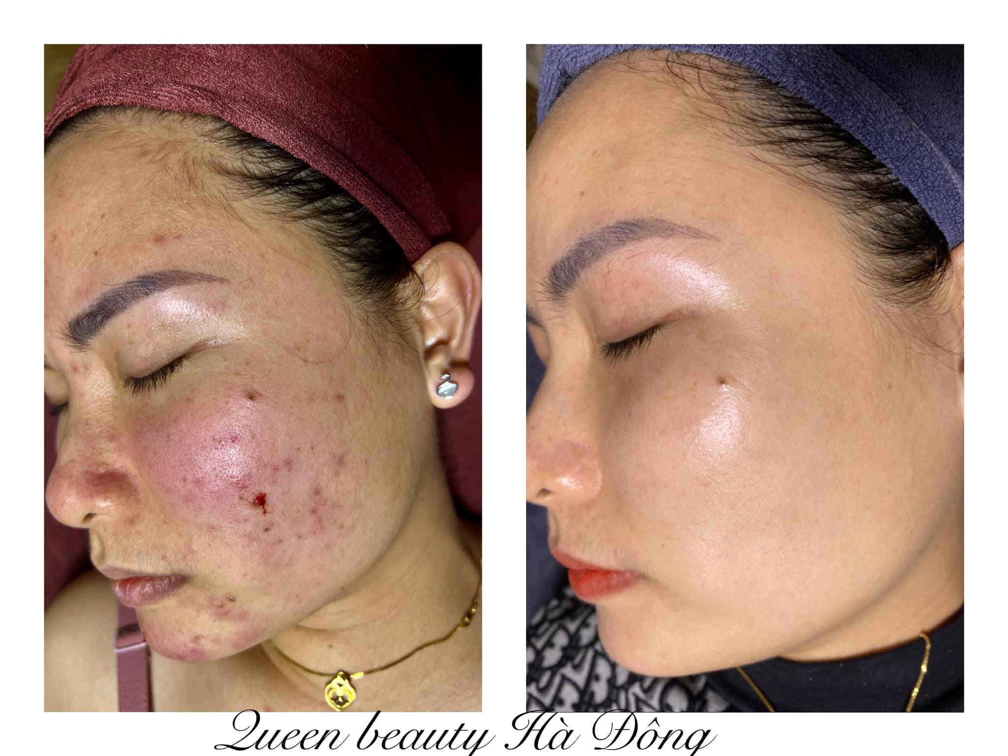 6 Địa chỉ spa trị mụn chất lượng hàng đầu tại Hà Đông, Hà Nội