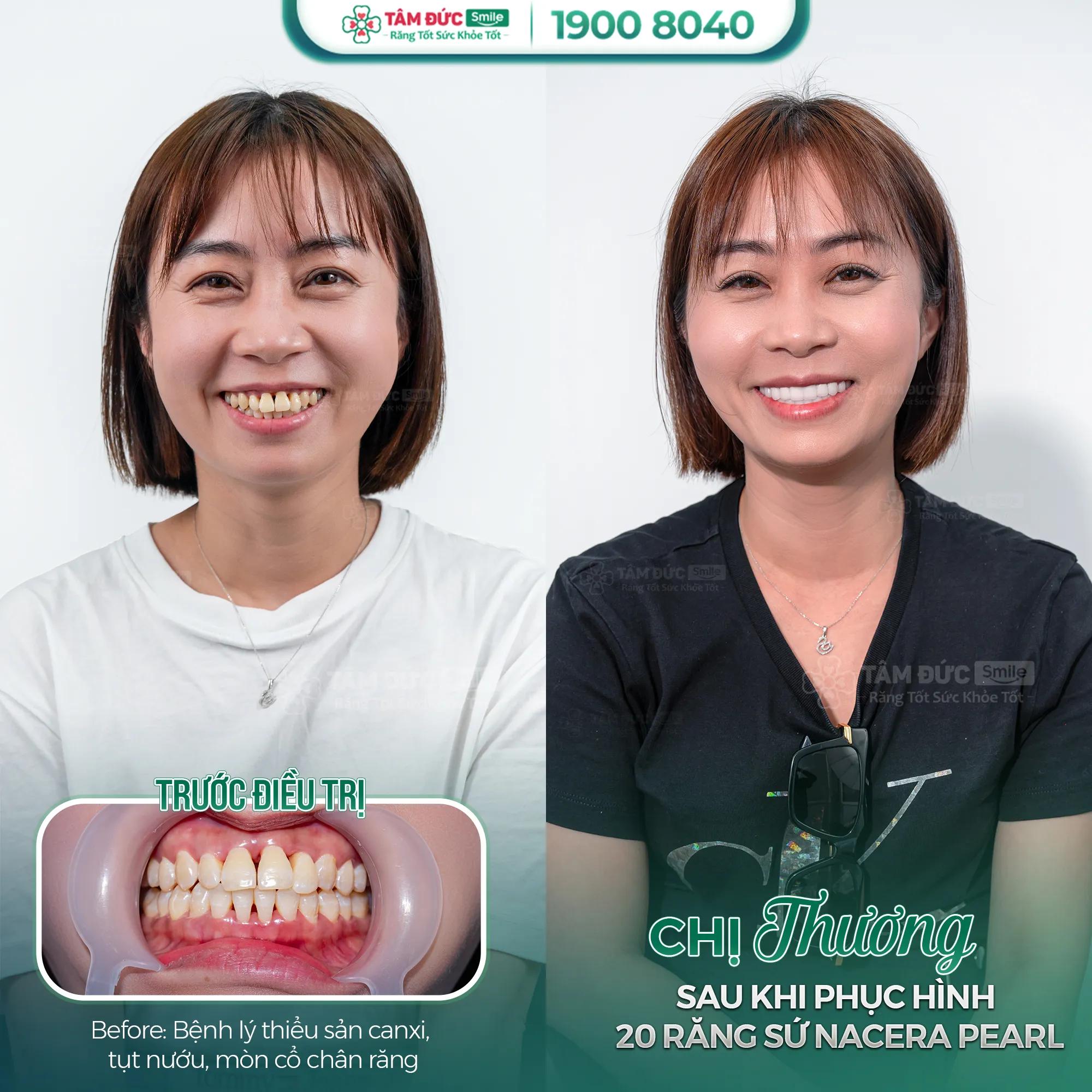 Top 10 địa chỉ bọc răng sứ đẹp và nổi tiếng nhất tại Cần Thơ