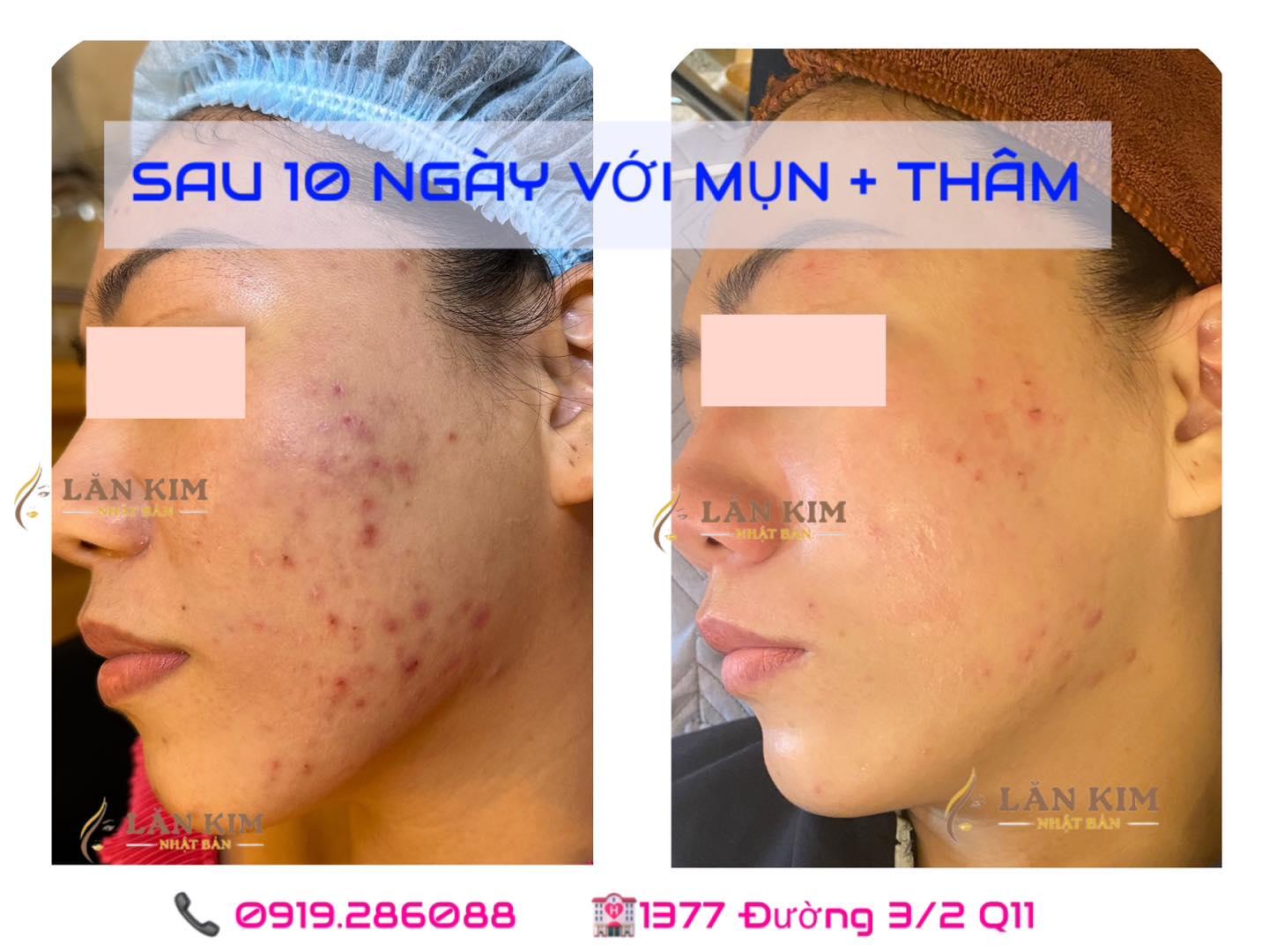 6 Địa chỉ trị mụn uy tín và hiệu quả hàng đầu tại Quận 11, TP.HCM