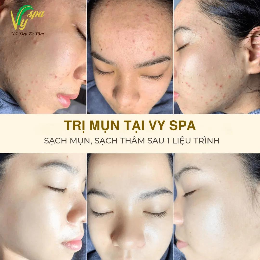 9 Địa chỉ Spa trị mụn uy tín và hiệu quả bậc nhất tại Quận 7, TP.HCM