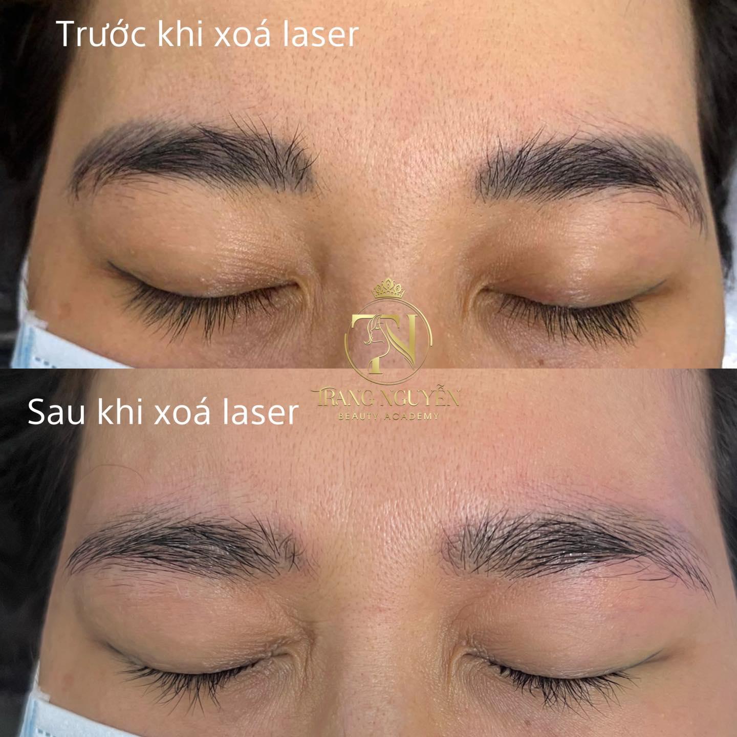 9 Địa điểm xóa xăm lông mày chất lượng nhất tại TP. Vinh, Nghệ An
