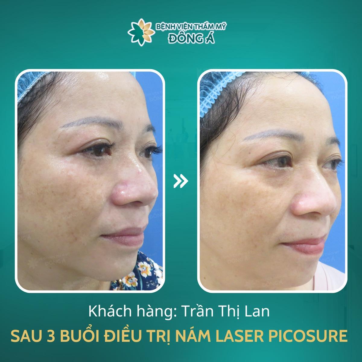 9 địa chỉ trị nám uy tín nhất tại Quận 5, TP.HCM – Giải pháp hoàn hảo cho làn da sạch nám