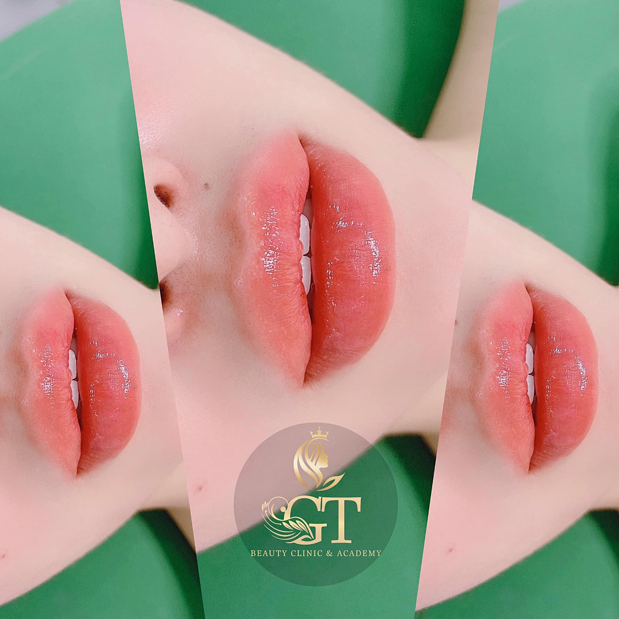 Top 10 địa chỉ tiêm filler - botox đáng tin cậy và đạt chuẩn chất lượng tại TP. Vinh, Nghệ An