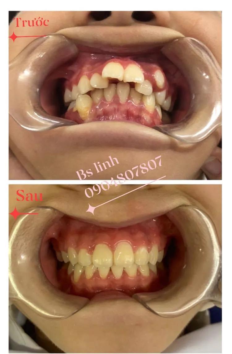 Top 7 Địa chỉ niềng răng uy tín tại Bắc Giang