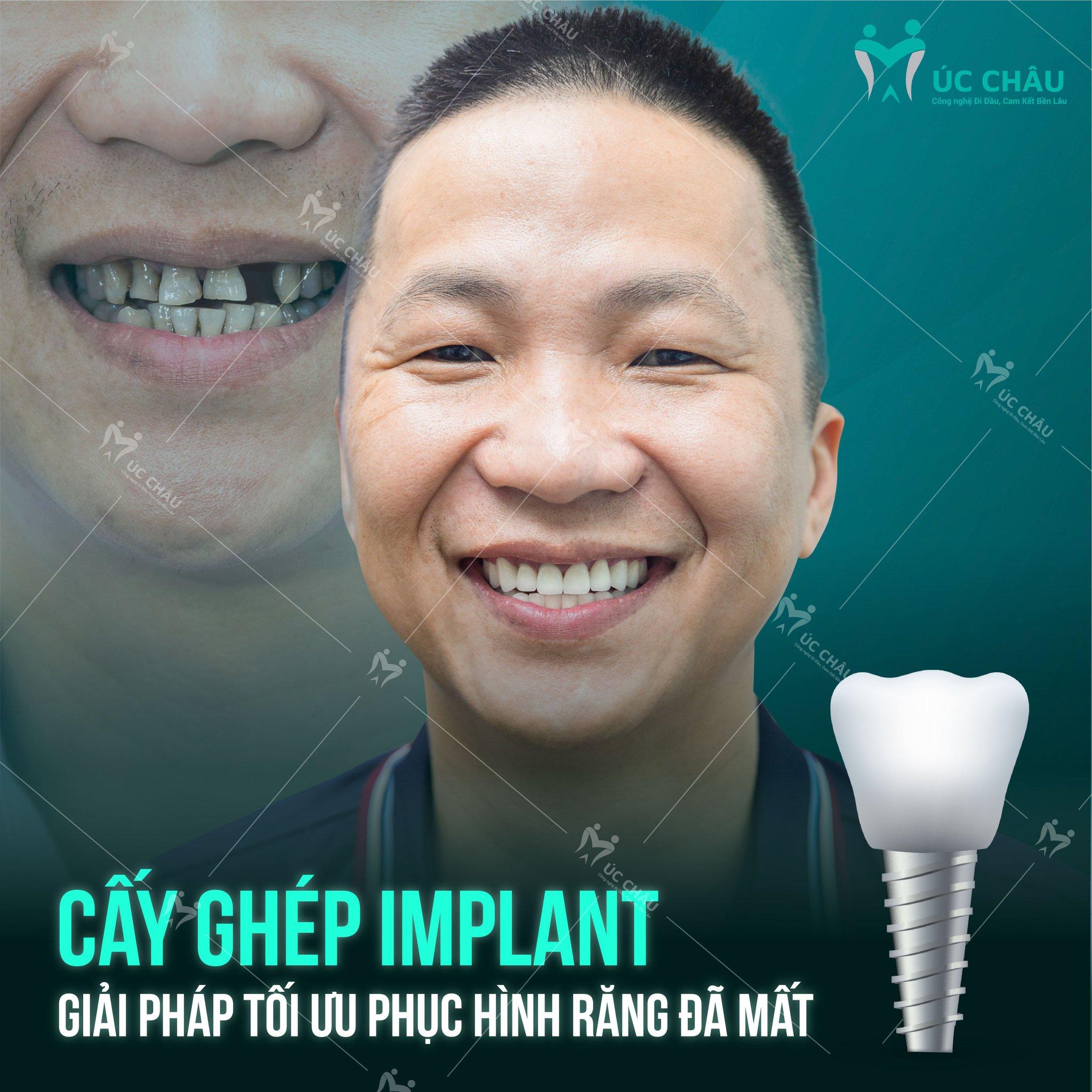 5 địa chỉ trồng răng implant chất lượng và uy tín hàng đầu tại Quảng Ninh