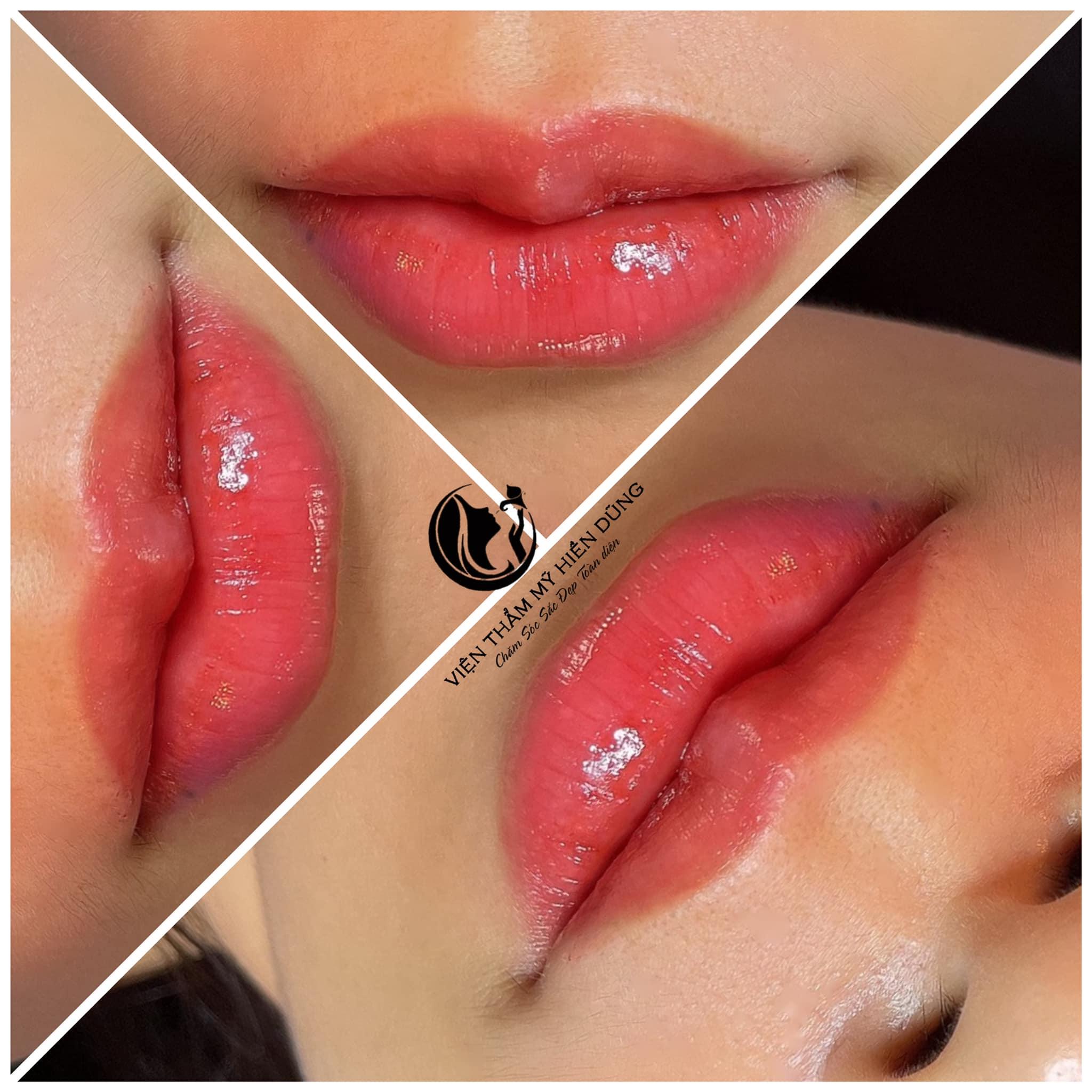 Top 5 địa chỉ tiêm filler - botox chất lượng và uy tín hàng đầu tại Lào Cai