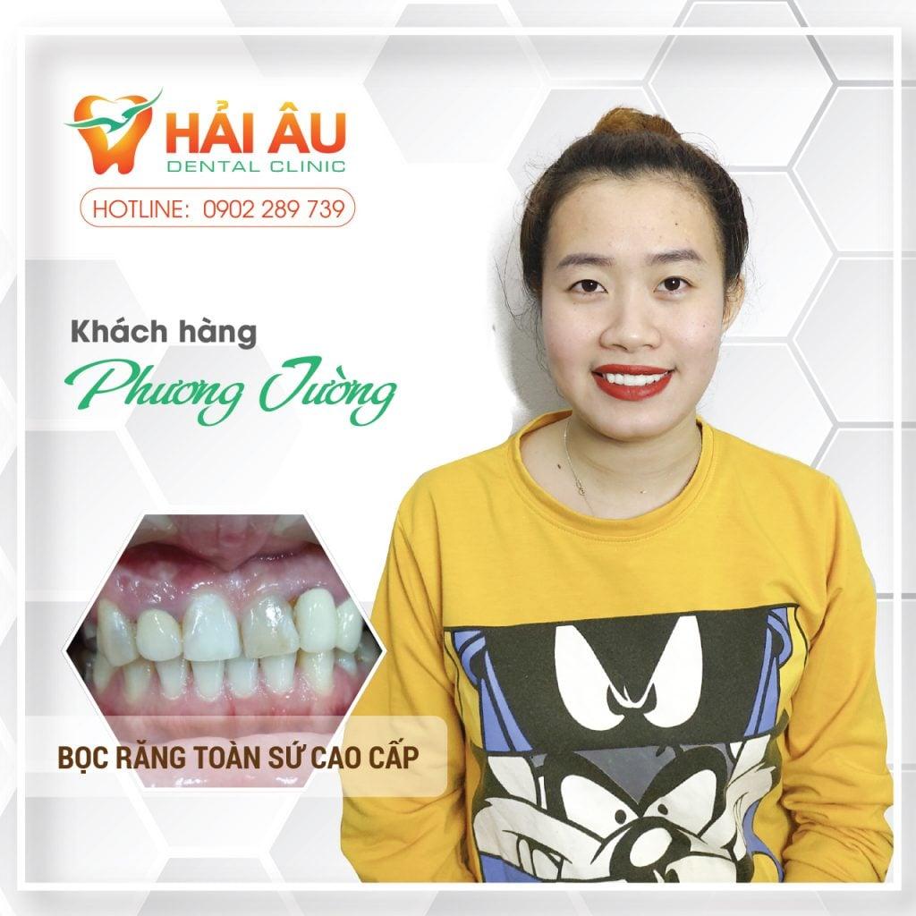 Top 6 địa chỉ bọc răng sứ chất lượng và uy tín hàng đầu tại quận Gò Vấp, TP. HCM