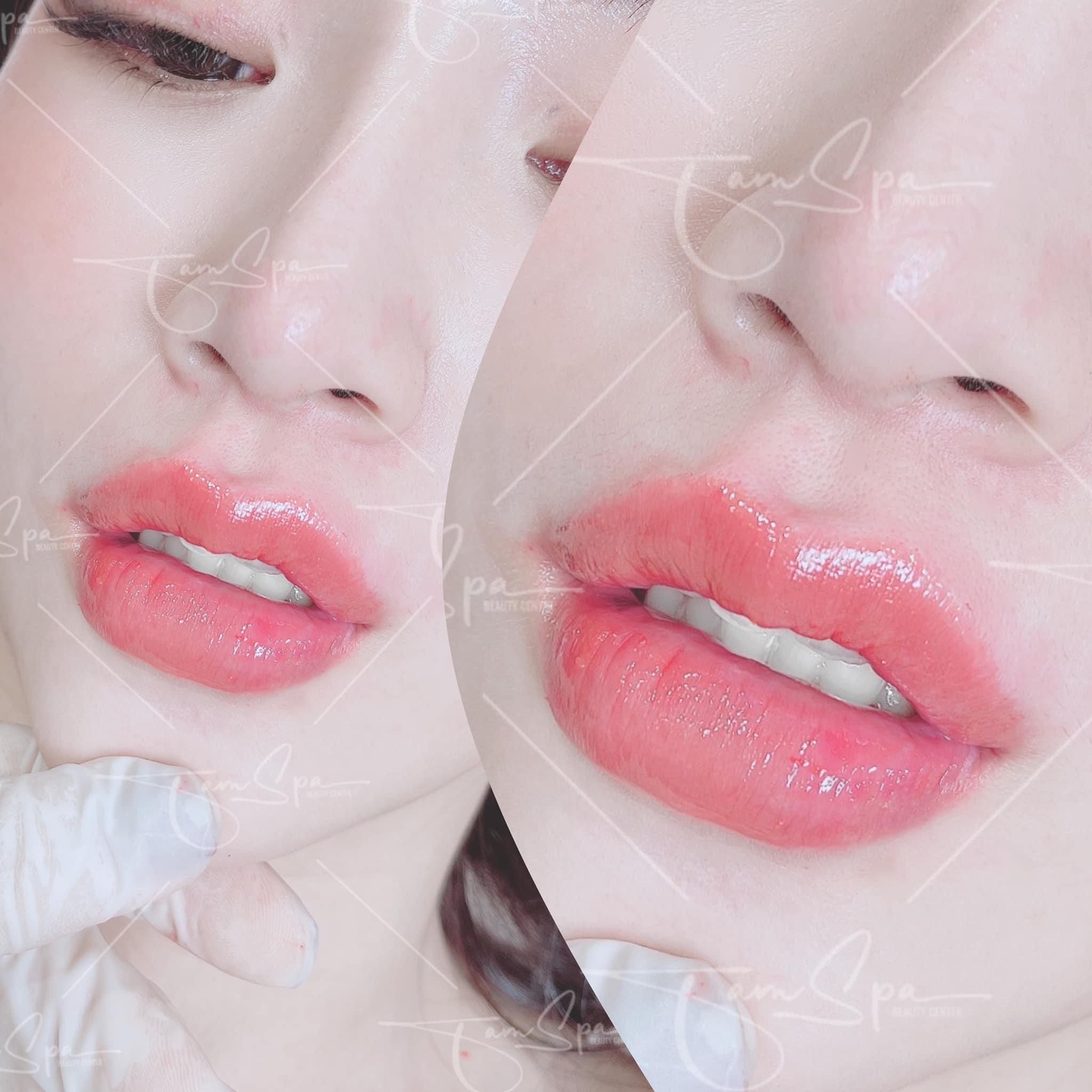 Top 10 địa chỉ tiêm filler - botox đáng tin cậy và chất lượng hàng đầu tại Nha Trang