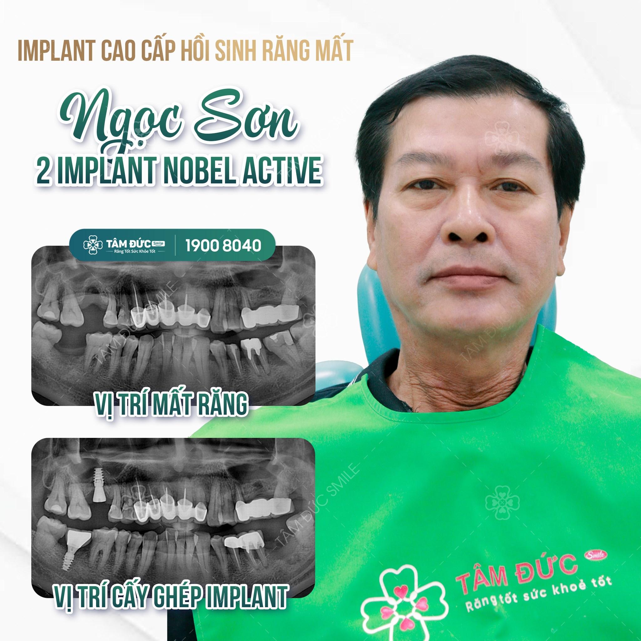 10 địa chỉ trồng răng implant chất lượng và uy tín bậc nhất TP HCM