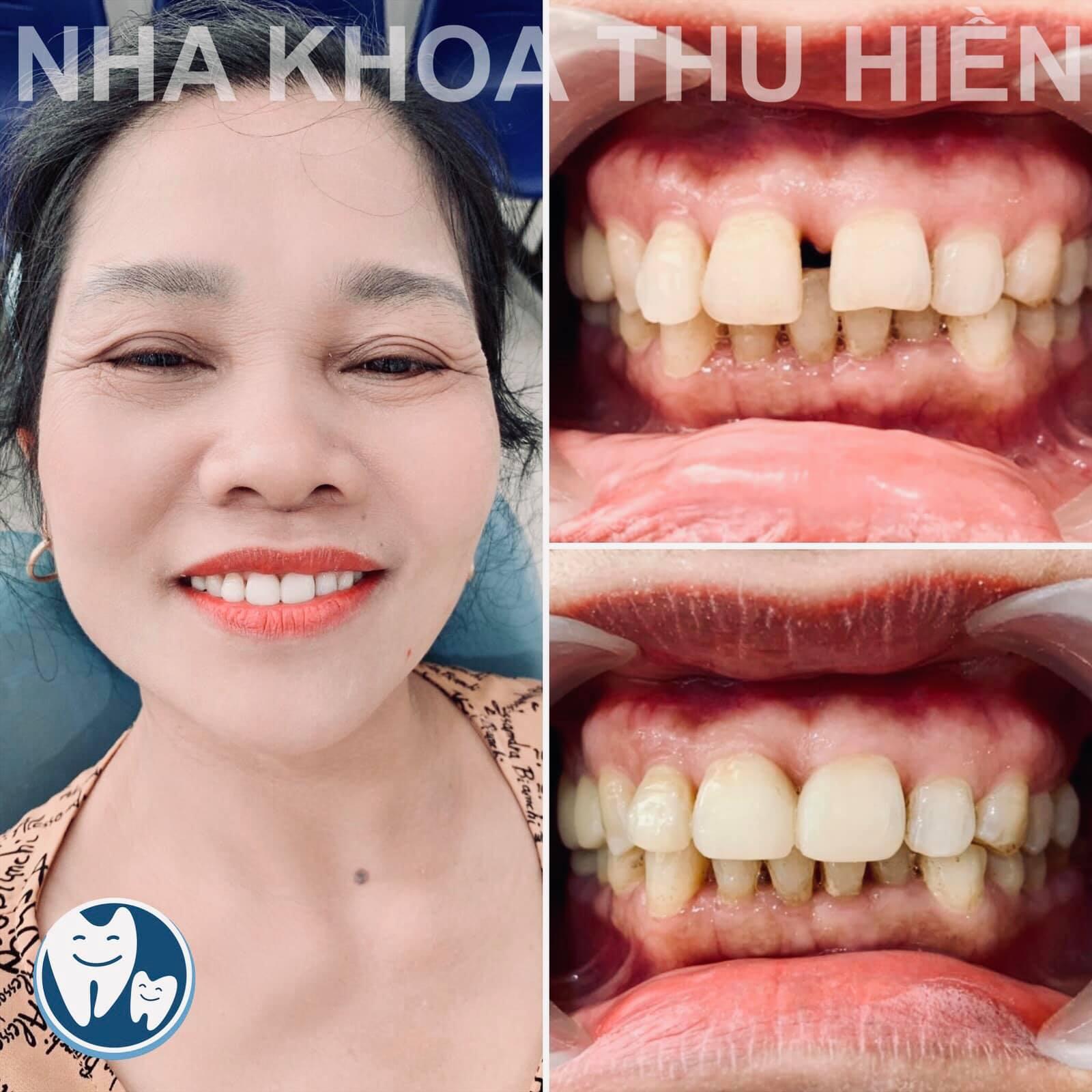 Top 6 địa chỉ tẩy trắng răng đáng tin cậy và chất lượng nhất tại TP. Vinh, Nghệ An