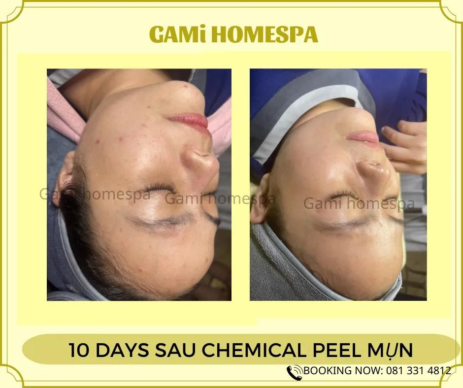 Top 9 đánh giá chi tiết nhất về dịch vụ trị mụn tại Gami Homespa
