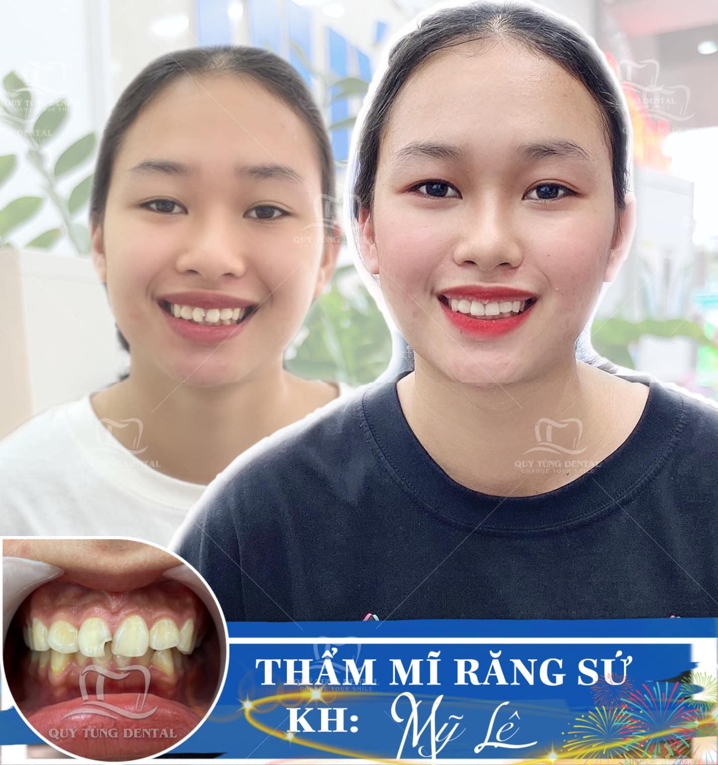 Top 5 địa chỉ bọc răng sứ thẩm mỹ và đáng tin cậy nhất tại Thái Nguyên