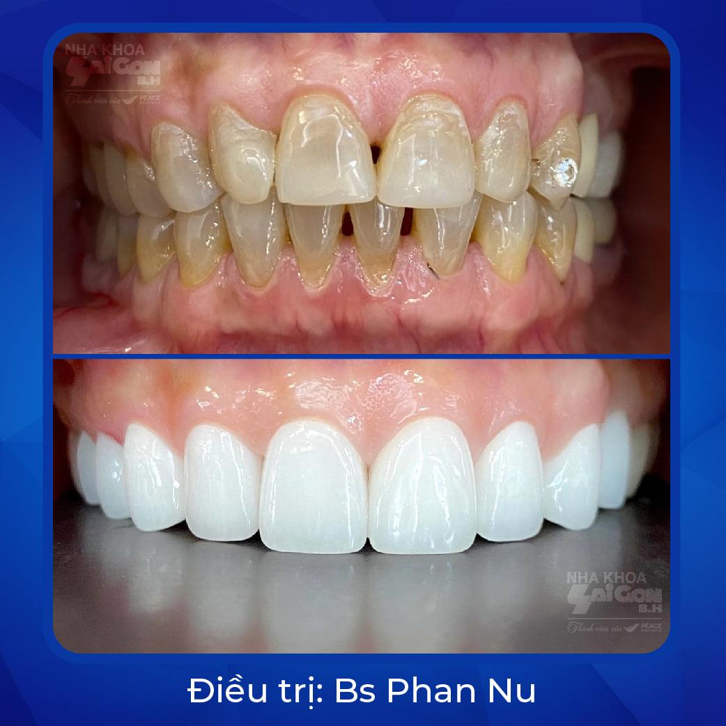Top 11 địa chỉ uy tín bọc răng sứ tại TP. Biên Hòa, Đồng Nai