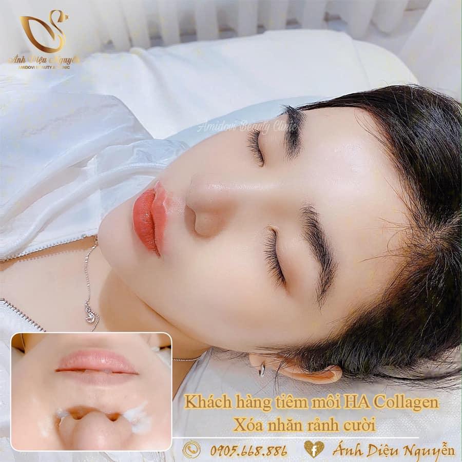 Top 9 địa chỉ tiêm filler - botox chất lượng và uy tín hàng đầu tại Đà Nẵng