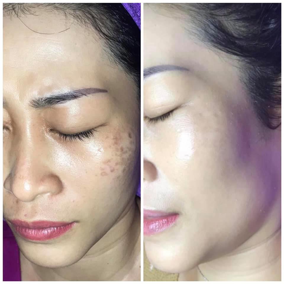 Top 4 Địa Chỉ Điều Trị Nám, Tàn Nhang, Đồi Mồi Hiệu Quả Nhất Tại Gia Lai