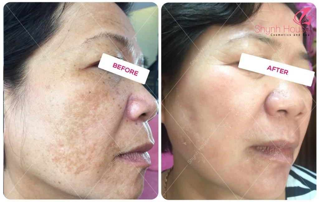 7 Địa chỉ trị nám, tàn nhang, đồi mồi hàng đầu tại Nha Trang