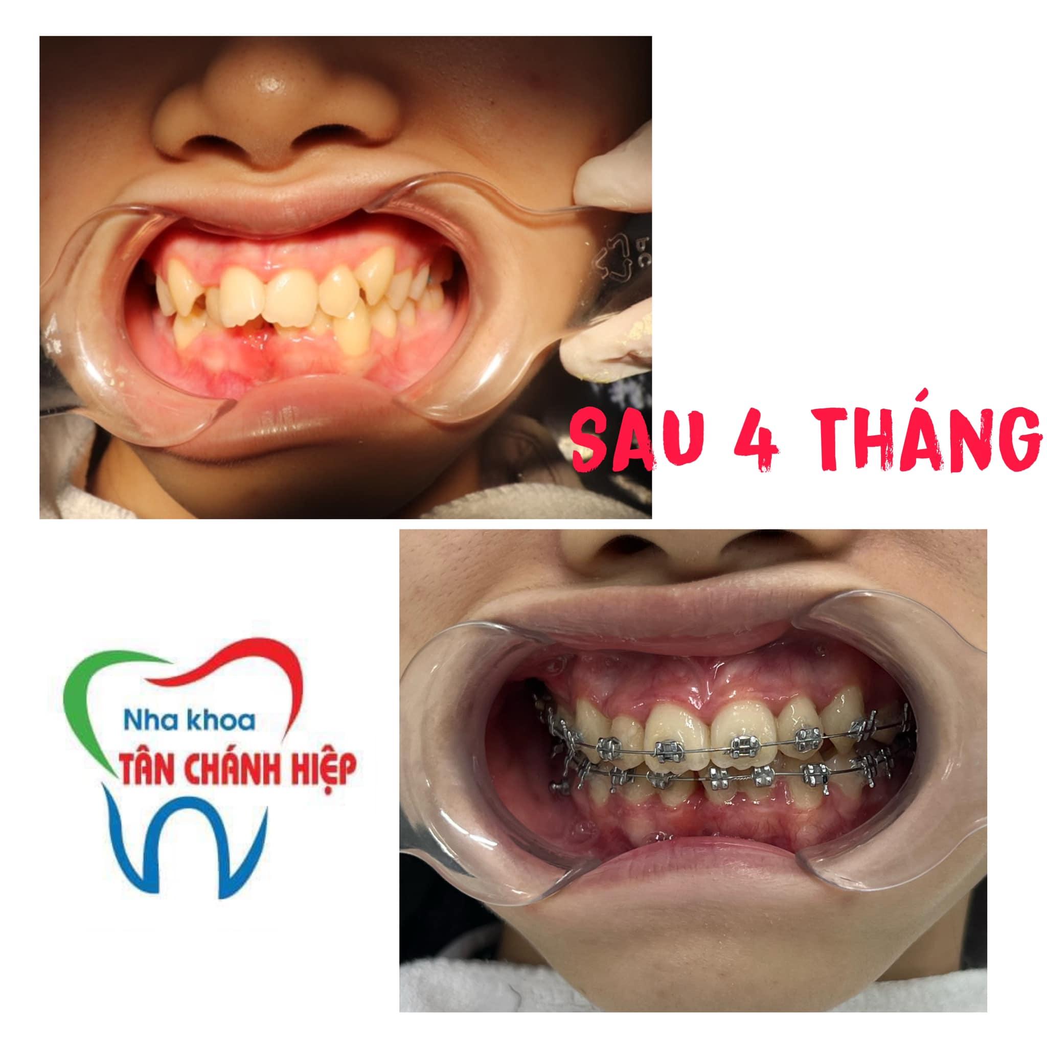 Top 5 địa chỉ niềng răng uy tín tại Quận 12, TP. HCM