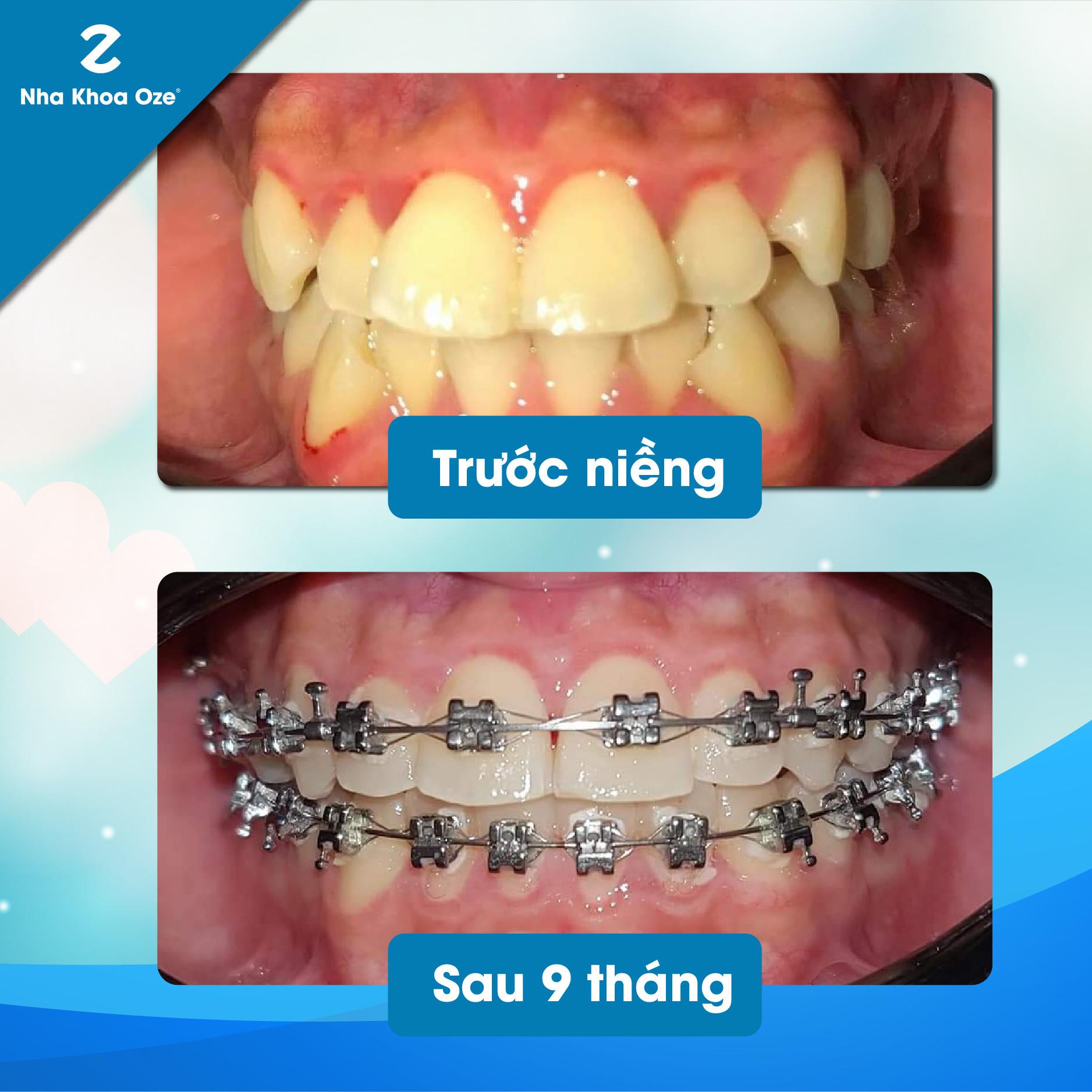 Top 5 địa chỉ niềng răng uy tín và chất lượng tại quận Hà Đông, Hà Nội