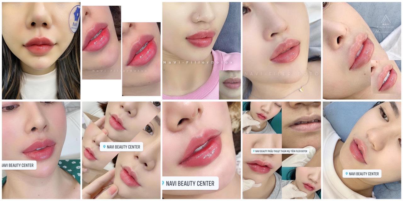 5 Địa điểm tiêm Filler - Botox đáng tin cậy hàng đầu tại quận 10, TP.HCM