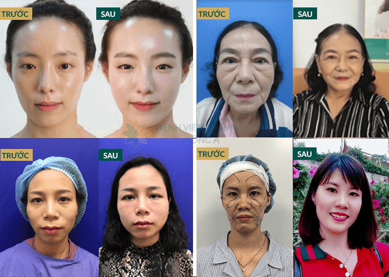 Top 6 địa chỉ cấy mỡ mặt uy tín và chất lượng hàng đầu tại TP HCM