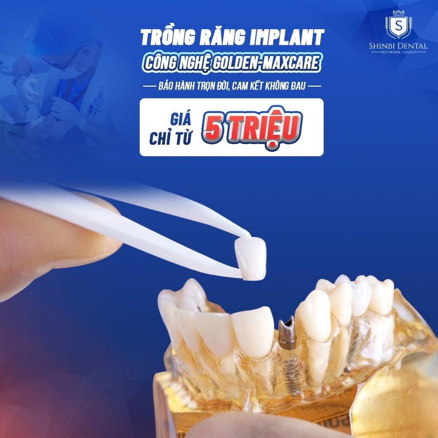 Top 5 địa điểm trồng răng implant đáng tin cậy nhất tại quận Hoàn Kiếm, Hà Nội
