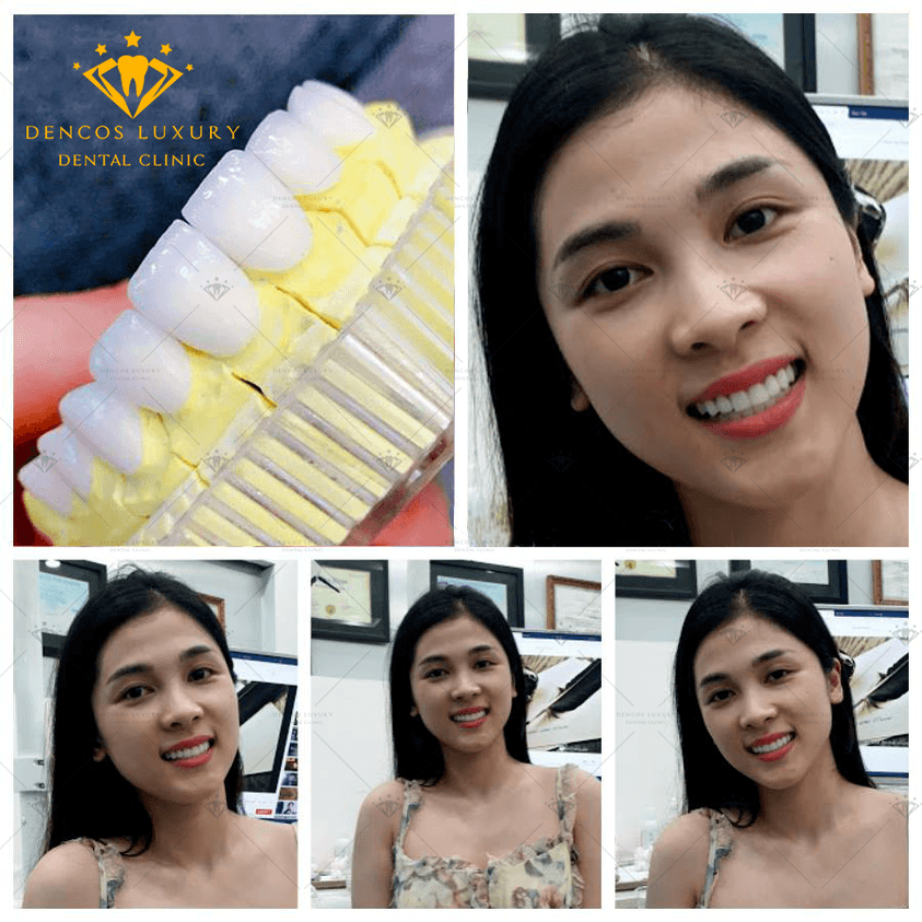Top 6 Địa chỉ uy tín để bọc răng sứ đẹp tại Thanh Hóa