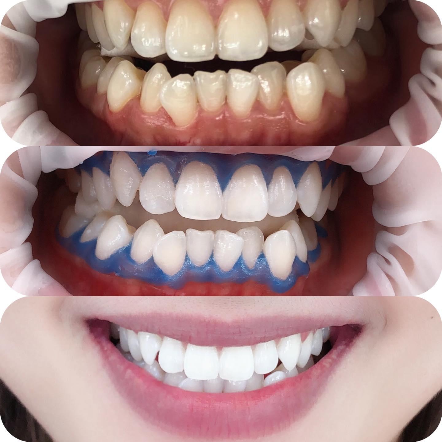 Top 5 Địa chỉ tẩy trắng răng đáng tin cậy tại Cần Thơ