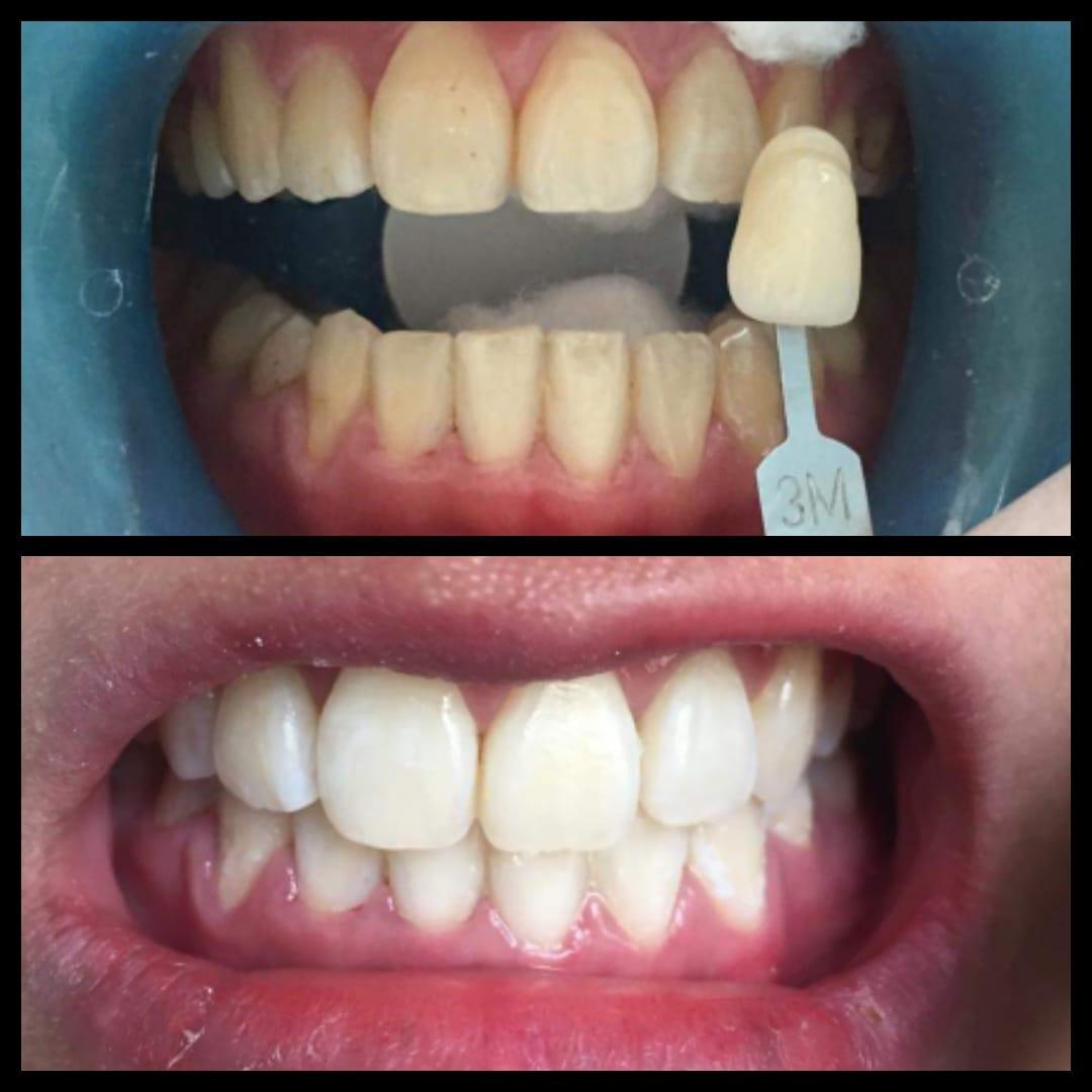 5 địa chỉ tẩy trắng răng đáng tin cậy nhất tại Quận 9, TP HCM