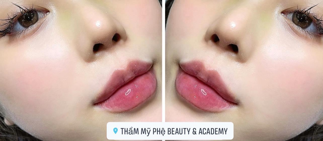 Top 9 địa chỉ tiêm filler - botox chất lượng và uy tín hàng đầu tại Bắc Giang