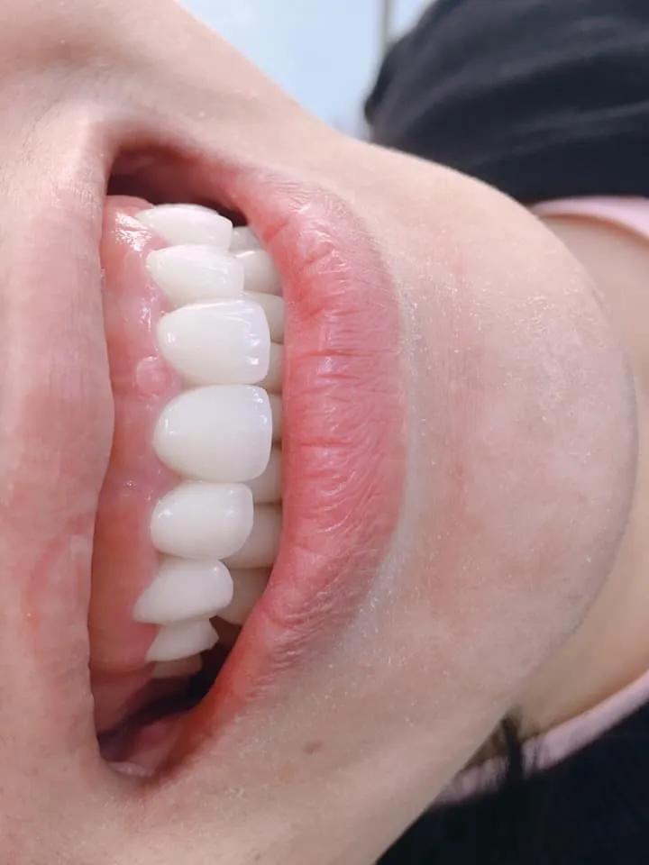 Top 5 Địa chỉ bọc răng sứ uy tín và chất lượng hàng đầu tại Ninh Bình
