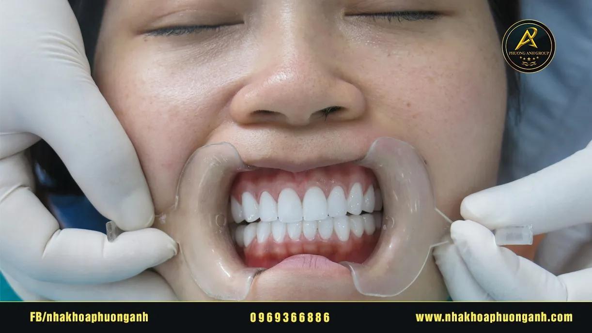 6 Địa chỉ bọc răng sứ chất lượng và thẩm mỹ hàng đầu tại quận Cầu Giấy, Hà Nội