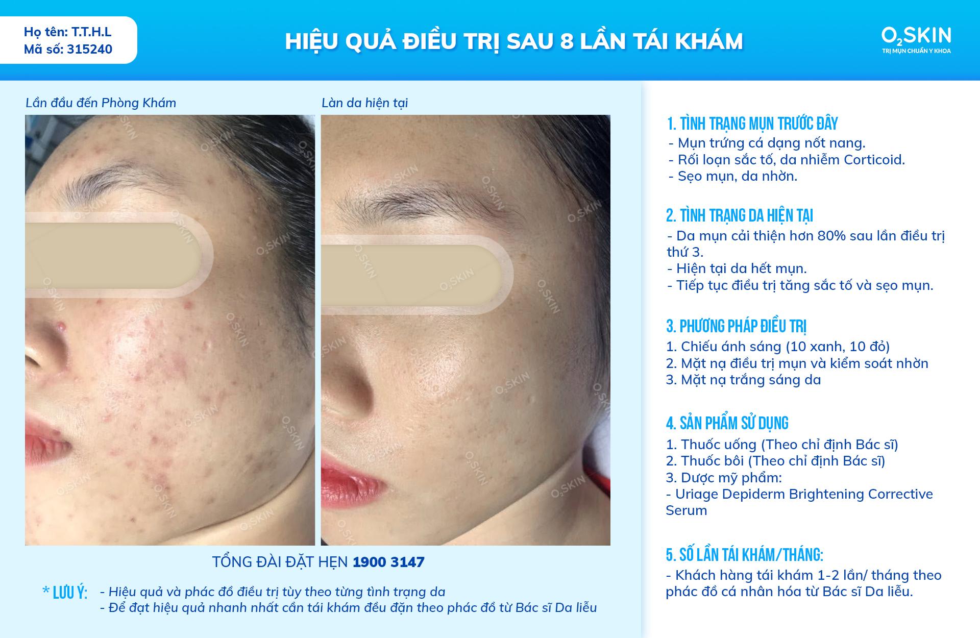 Top 5 đánh giá chân thực nhất về liệu trình trị mụn tại Phòng Khám Da Liễu O2 SKIN