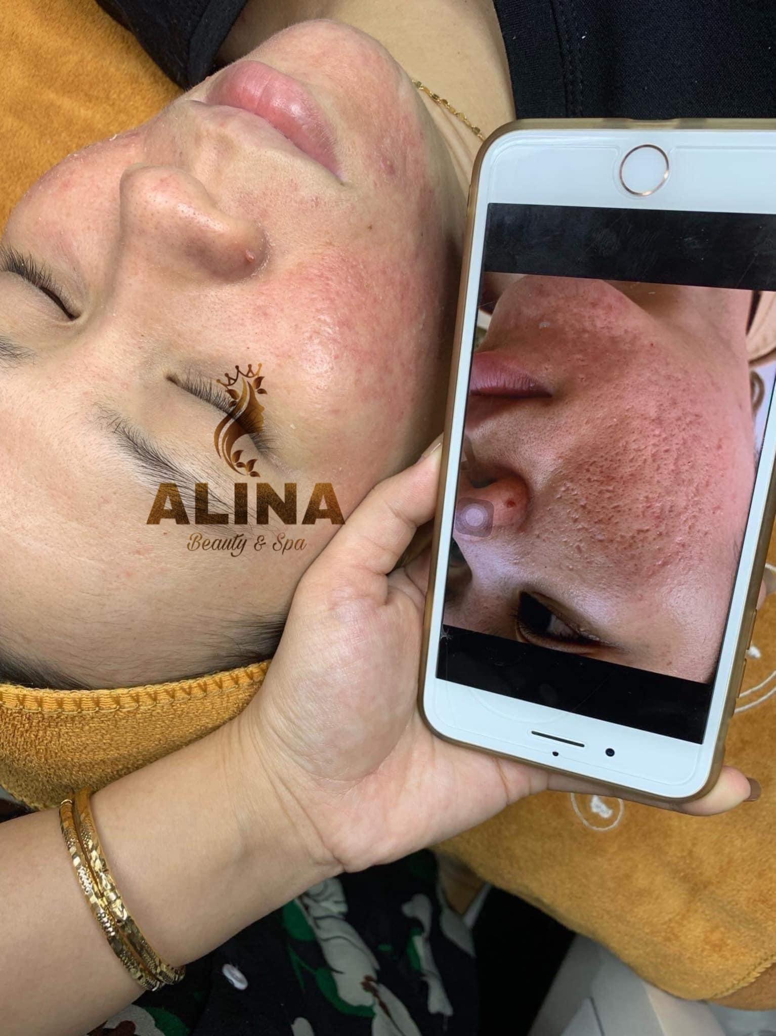 7 Địa chỉ điều trị sẹo rỗ, sẹo mụn hiệu quả & đạt chuẩn y khoa hàng đầu tại Cần Thơ