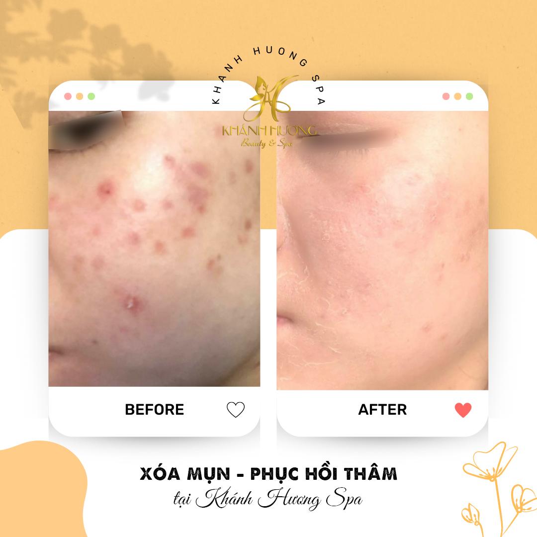 9 địa chỉ spa trị mụn uy tín nhất Quận 5, TP.HCM - Hiệu quả đã được kiểm chứng
