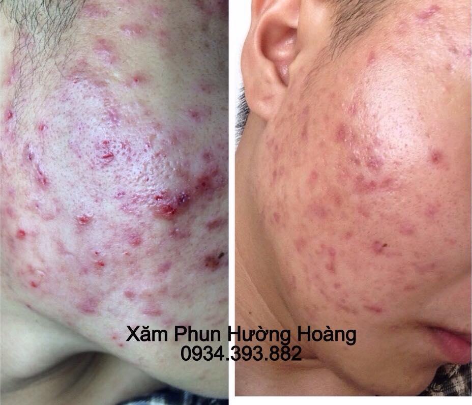 Top 8 Spa trị mụn uy tín và hiệu quả nhất tại Ninh Bình