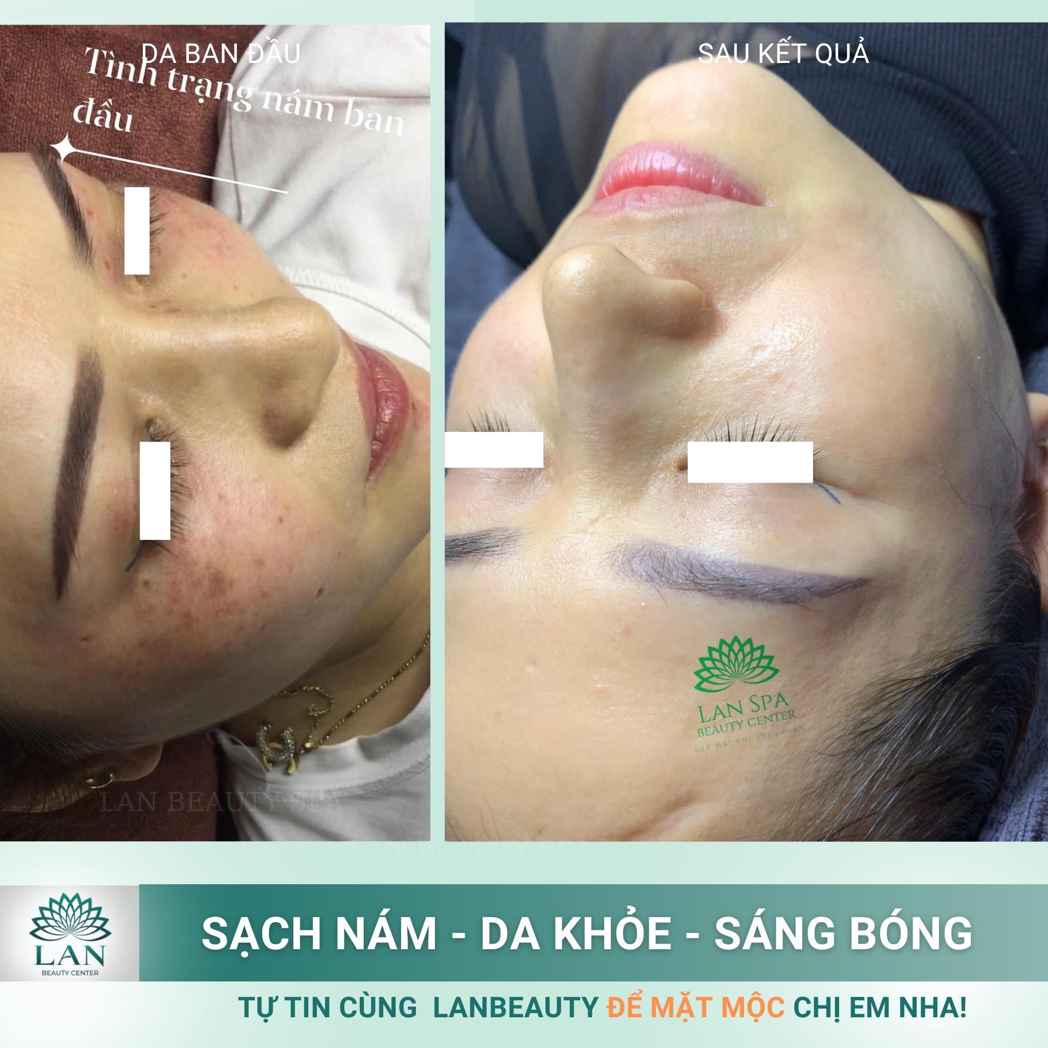 7 Địa Chỉ Trị Nám, Tàn Nhang & Đồi Mồi Hiệu Quả Nhất Tại Hải Dương