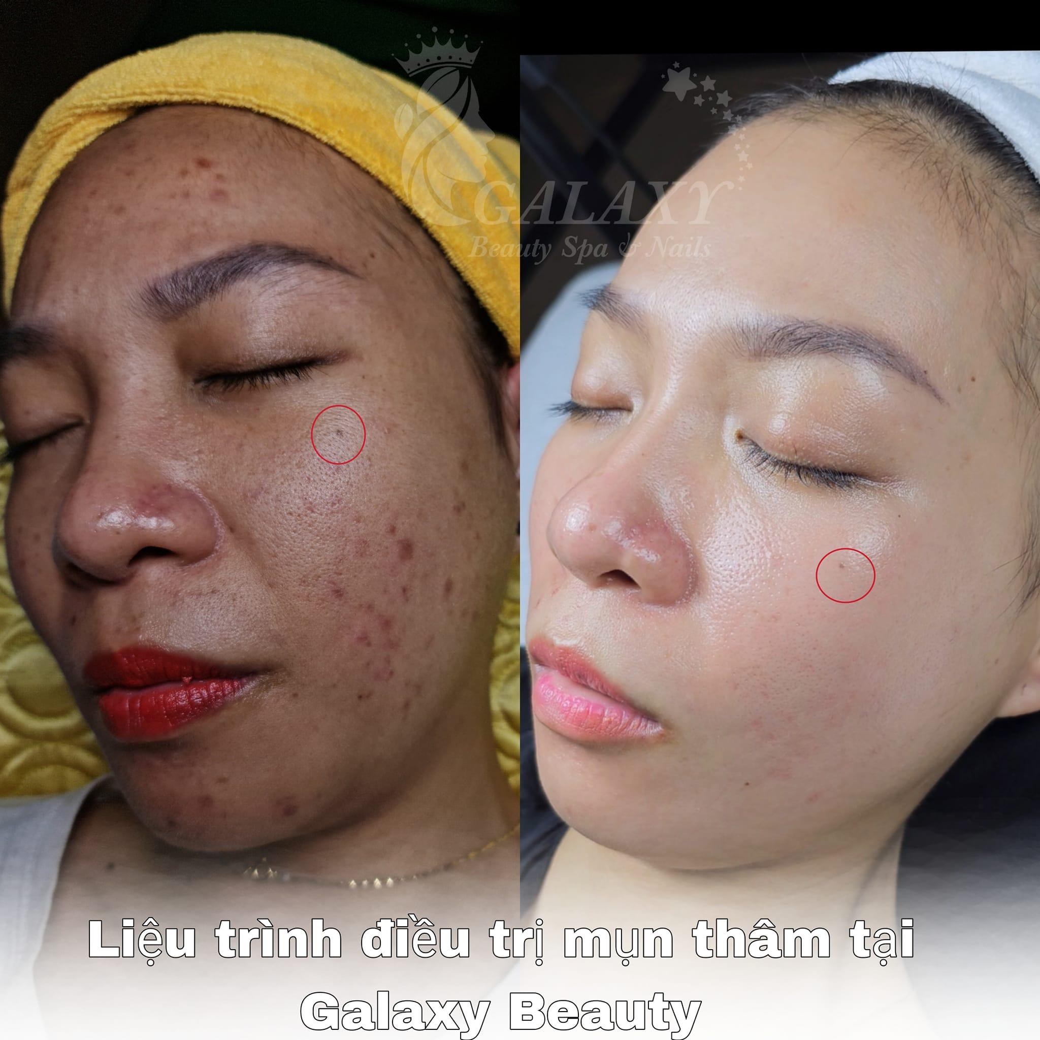 Khám phá 9 địa chỉ hàng đầu tại Đà Nẵng chuyên điều trị mụn và lấy nhân mụn chuẩn y khoa, mang lại giải pháp hoàn hảo cho làn da mịn màng, khỏe mạnh. Những cơ sở này sẽ giúp bạn loại bỏ mụn nhanh chóng và hiệu quả nhất, phục hồi làn da sáng đẹp, không tỳ vết.