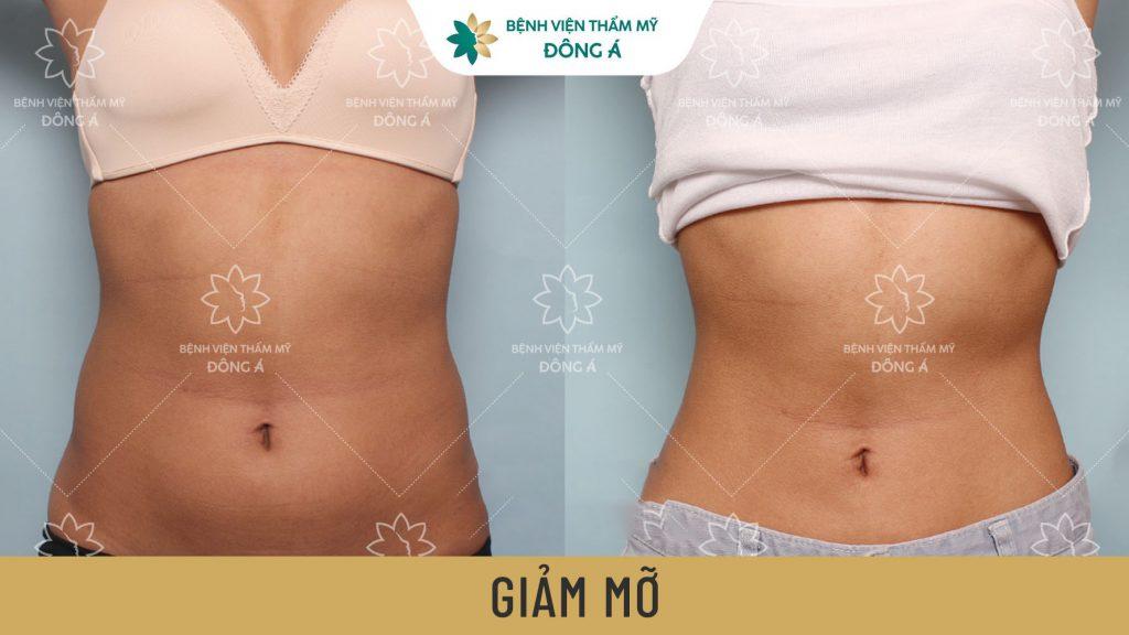 Top 7 địa chỉ hút mỡ bụng an toàn và hiệu quả nhất tại Hà Nội