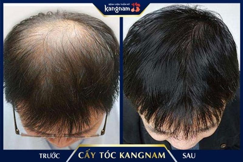 6 địa chỉ cấy tóc uy tín và chất lượng nhất Hà Nội