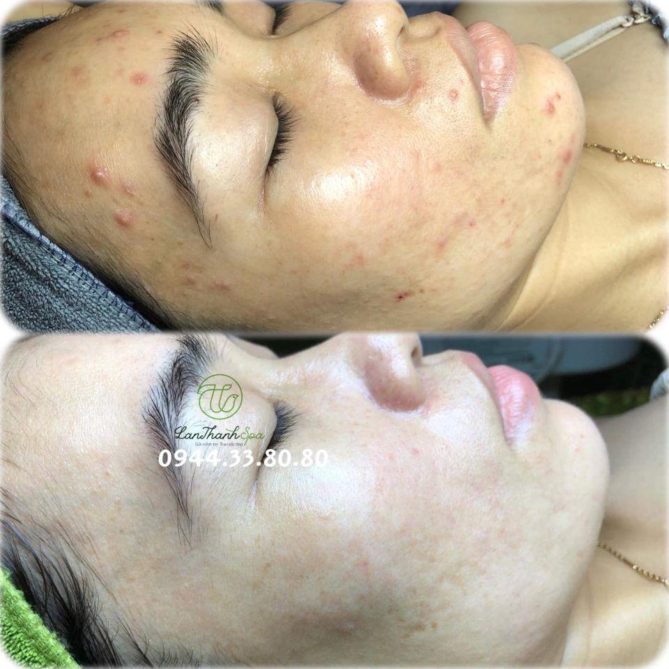 8 Địa Chỉ Spa Trị Mụn Chất Lượng Nhất Thủ Dầu Một, Bình Dương