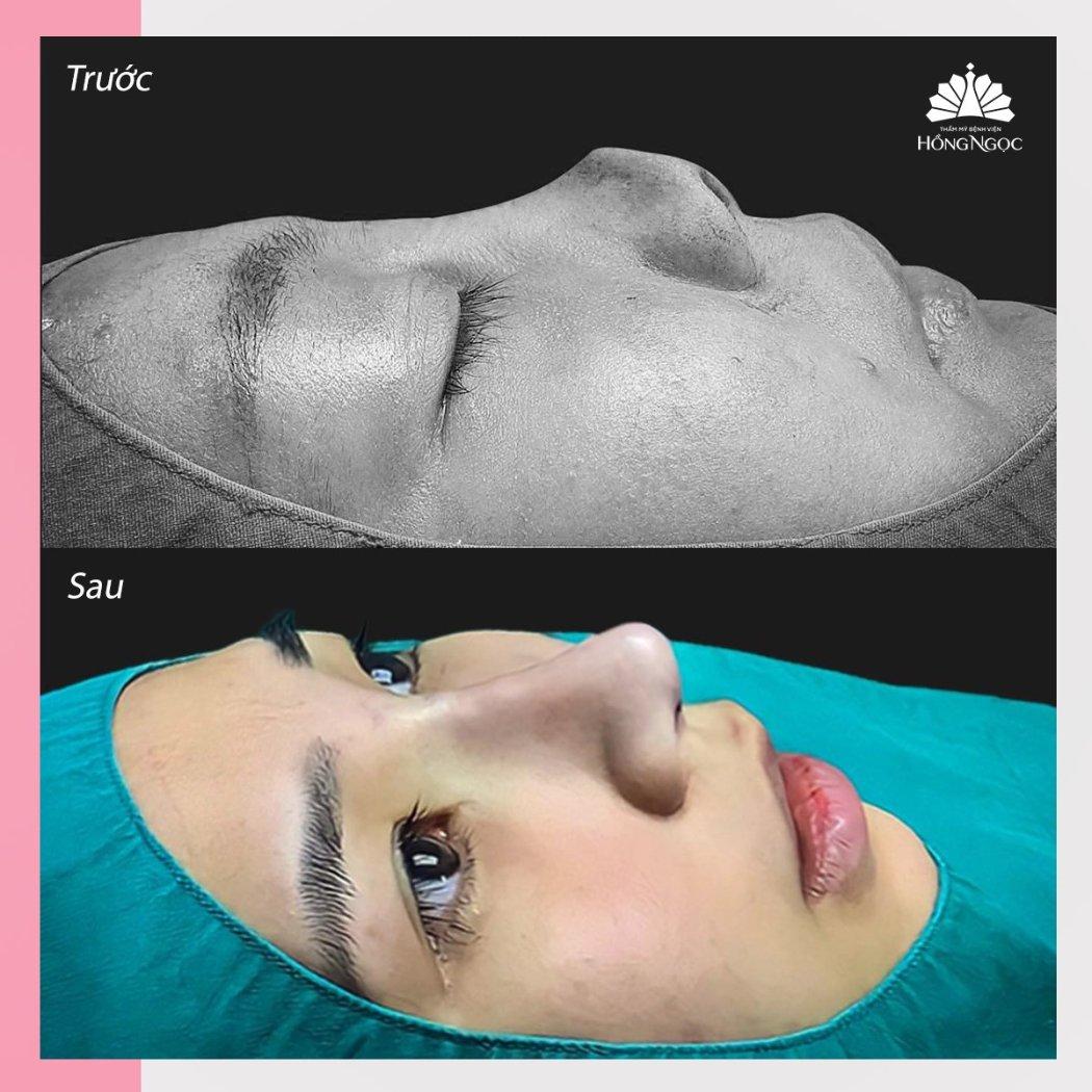 Top 5 Địa chỉ sửa mũi hỏng uy tín tại Hà Nội