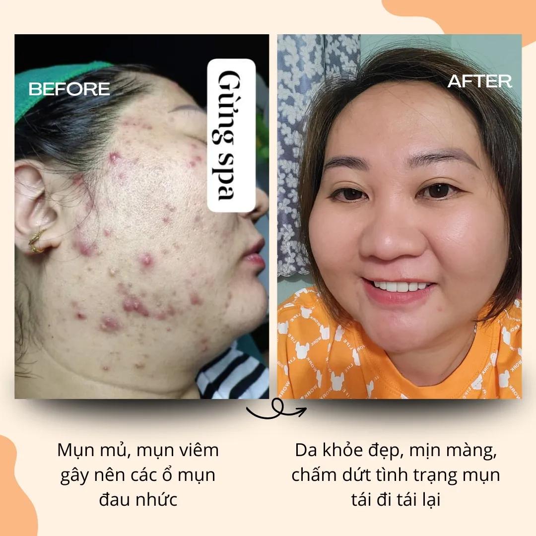Top 5 spa trị mụn hiệu quả nhất tại Quận 4, TP. HCM