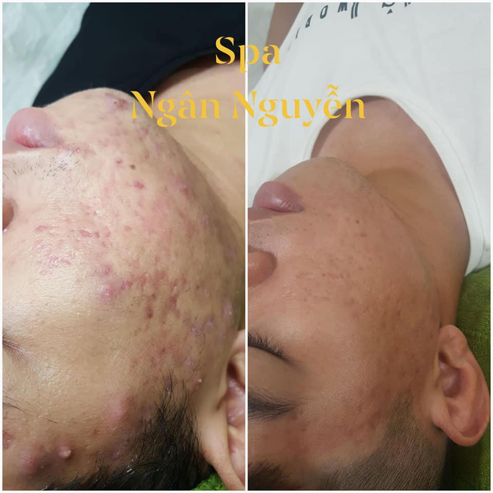 7 Địa chỉ spa trị mụn chất lượng và đáng tin cậy nhất tại Tuy Phong, Bình Thuận